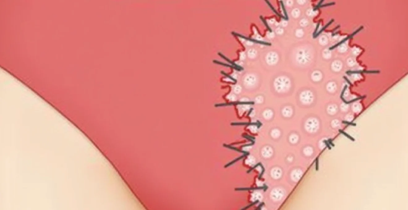 paper-cut-like-sores-on-the-labia-causes