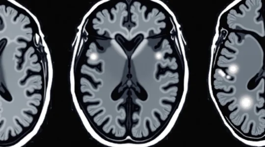 what-white-spots-on-a-brain-mri-can-mean